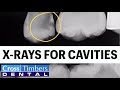 Dental X-Rays and Cavity Detection