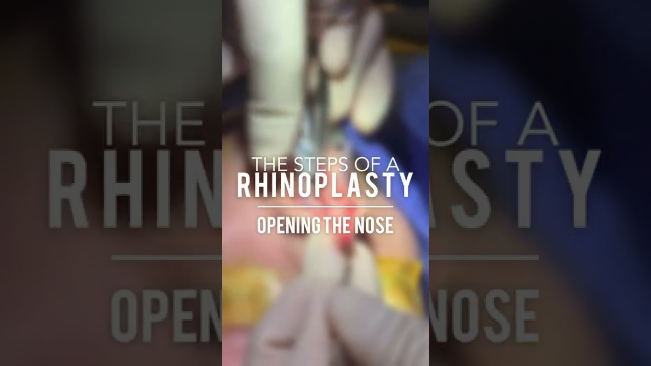 Rhinoplasty procedure illustrating nose opening steps.