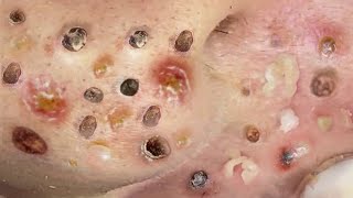 Loan Nguyen Acne Treatment 126c
