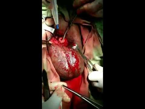 Penectomy Pictures