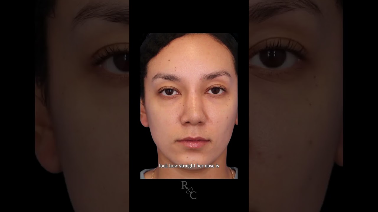 Rhinoplasty Reveal