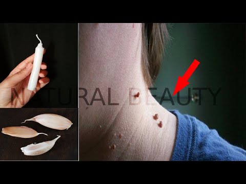 بشمعة واحدة فقط تخلصي من الثآليل ستتختفي  / علاج الزوائد الجلدية في 3 أيام ستختفي ولن تظهر مجددا