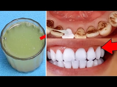 2 मिनिट में गंदे पिले दातों को मोती की तरह चमका देगा ये कमाल का नुस्खा | Teeth Whitening Formula