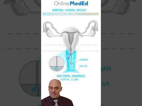 Clinical Case: Managing a Positive Gonorrhea NAT & Preventing PID