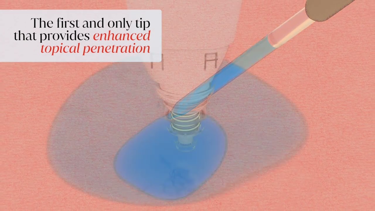 Enhanced topical penetration tip demonstration.