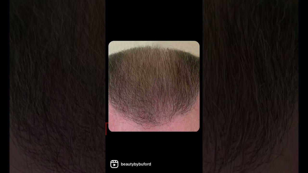 Top view of thinning hair on a scalp.