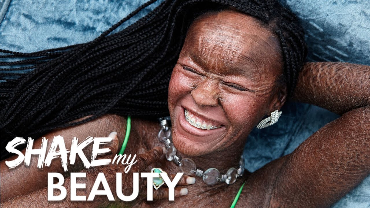 I'm owning my skin condition by modelling for glamour - shake my beauty