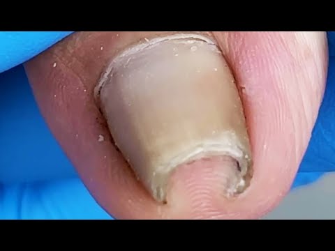 Amazing! Ingrown nails extremely curly【Xue Yidao】