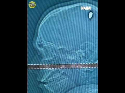 This guy found out after 3 days that a bullet had entered his head ? #shorts #ytshorts
