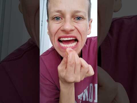 перестала чистить зубы. результаты #зубы #зубыдоипосле #здоровьезубов #безхимии #народнаямедицина