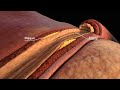 Understanding Cholesterol and Its Management