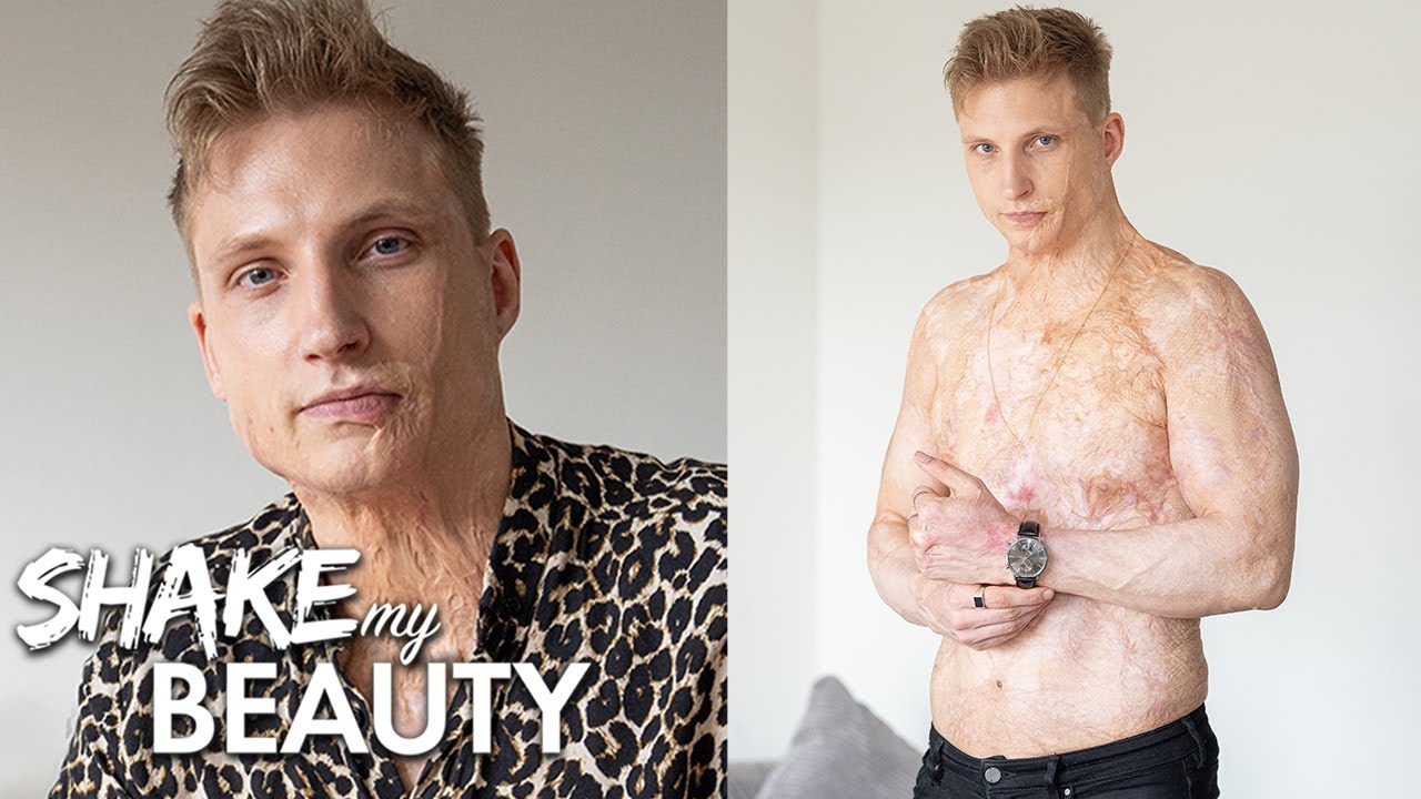 I was electrocuted and burned 70% of my body - shake my beauty