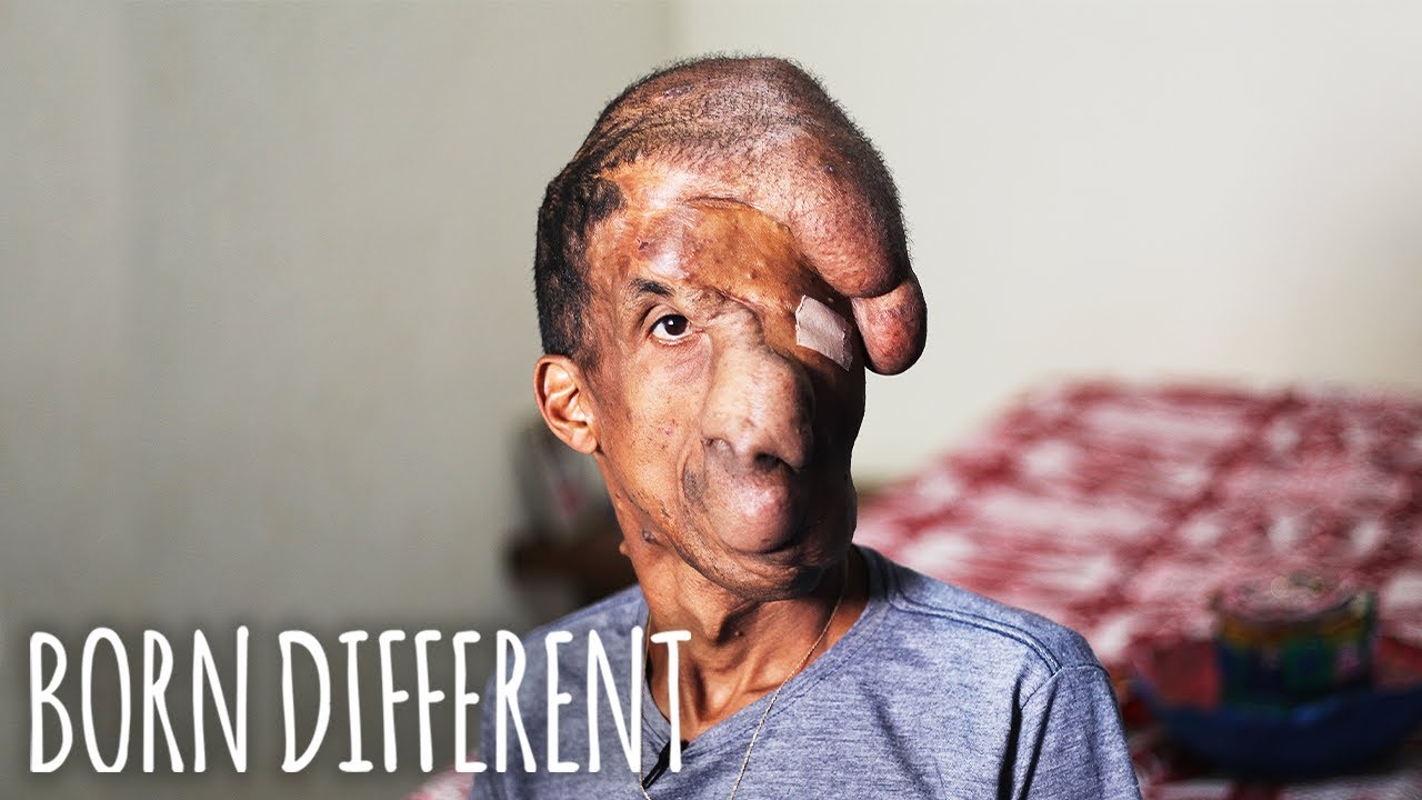 A tumour has taken over my face - born different