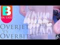 Understanding Overbite and Overjet