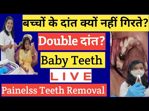 Bacho Ke Dant |Baby Teeth |बच्चों के दांत क्यों नहीं गिरते? |Teeth Removal |Dudh Ke Dant |Doctor 💊