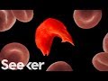 Sickle Cell Anemia Insights