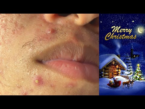 Staff of Huong Da Nang_ Purulent acne PArt 2#720     Merry Christmas 2024