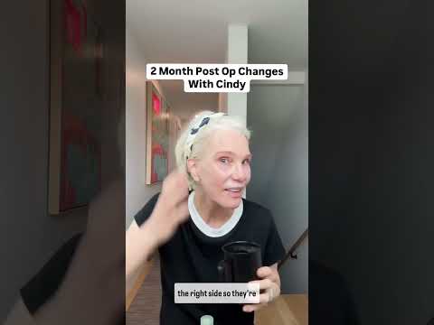 2 Month Facelift Healing & Recovery Check-in!