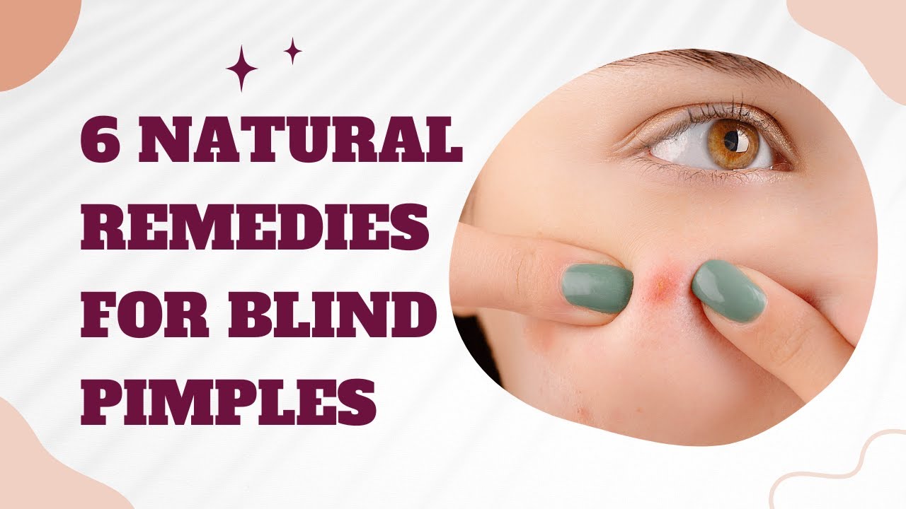6 Natural Remedies for Blind Pimples