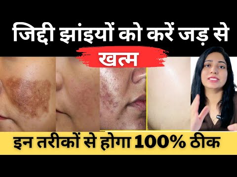 चेहरे की काली झाईयों को जड़ से ख़त्म करने के घरेलू तरीके | Home Remedies For Pigmentation |