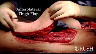 Anterolateral Thigh Flap