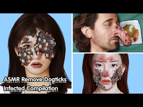 ASMR Remove Dogticks Infected Compilation - Deep Cleaning Animation