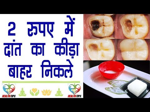 सिर्फ एक बार इस्तेमाल से दांत का कीड़ा बाहर निकालें || How To Get Rid Of Tooth Cavity 100% Effective