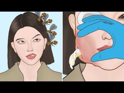 ASMR Best Treatment for Bee Sting Swollen face Severely Injured Animation Part 2