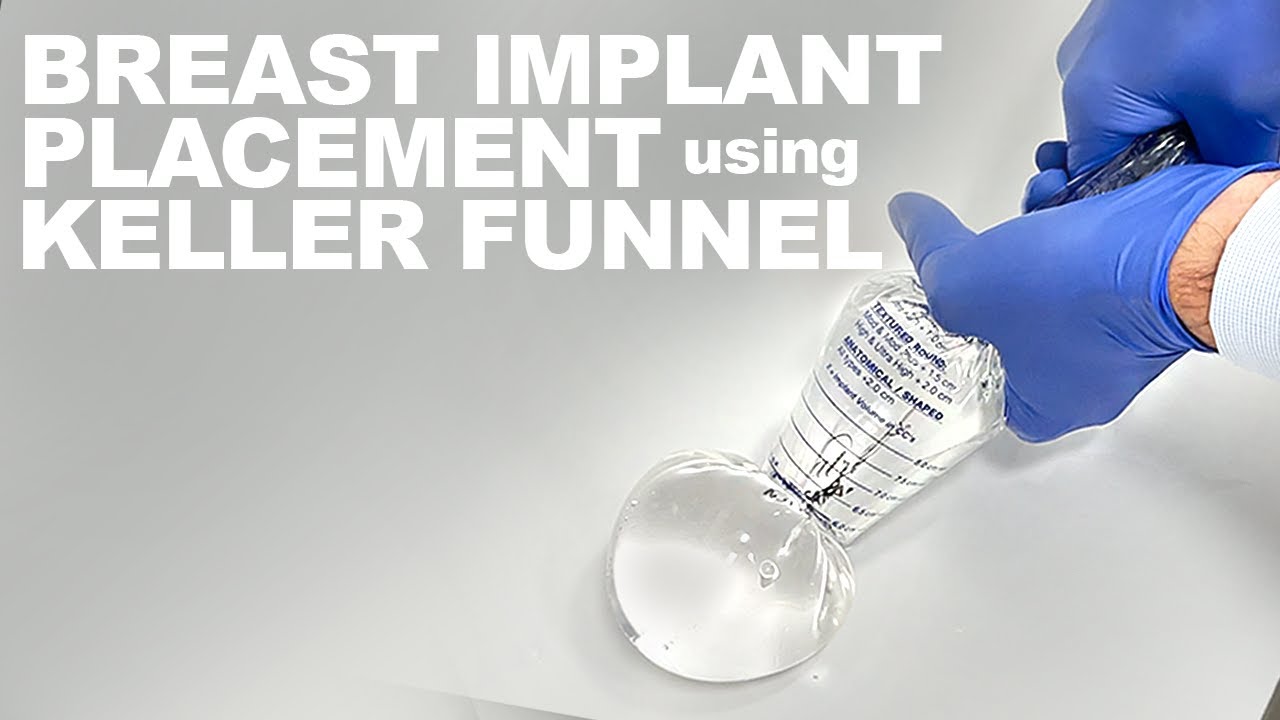 Breast implant placement with Keller Funnel technique