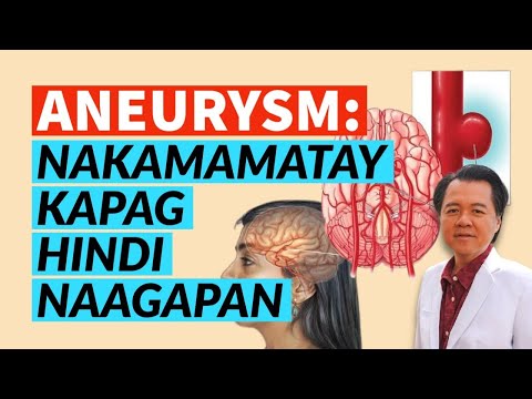 Aneurysm: Nakamamatay Kapag Hindi Naagapan (Repost Video)