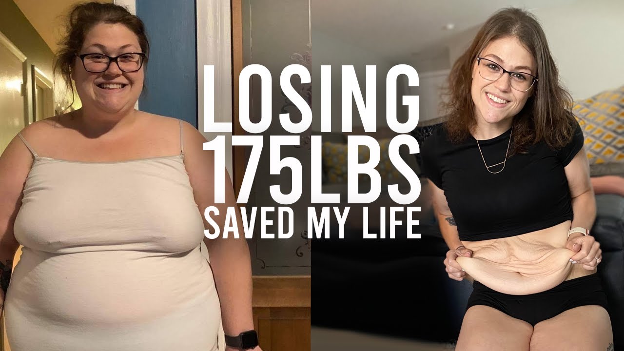 I've been left with 10lbs of excess skin - brand new me