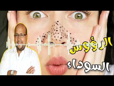 إزالة الرؤوس السوداء من الوجه بوصفة طبيعية بسيطة  مع الدكتور عماد ميزاب