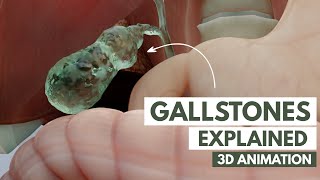 What are Gallstones? | 3D Animation