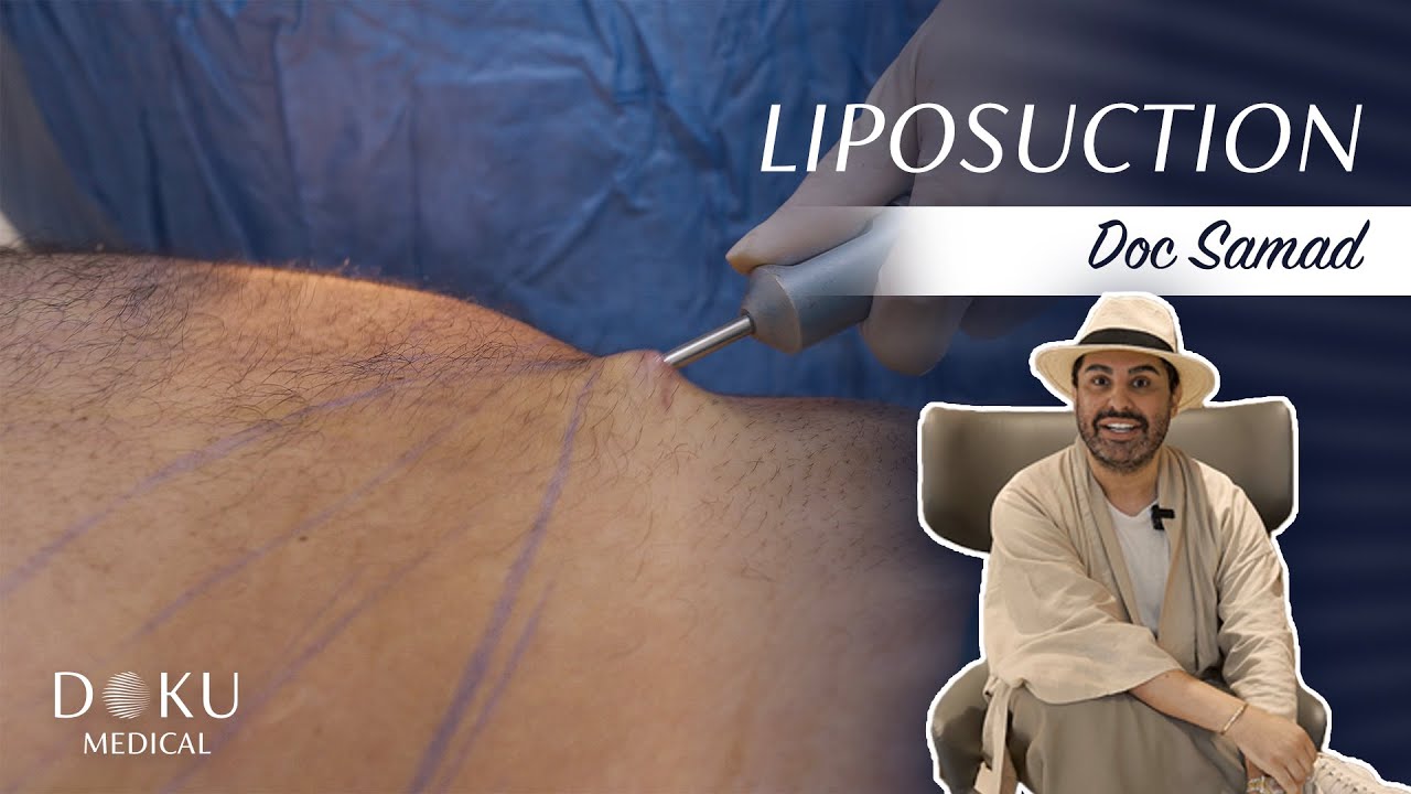 Doc Samad ile Liposuction & Saç Ekimi Deneyimi