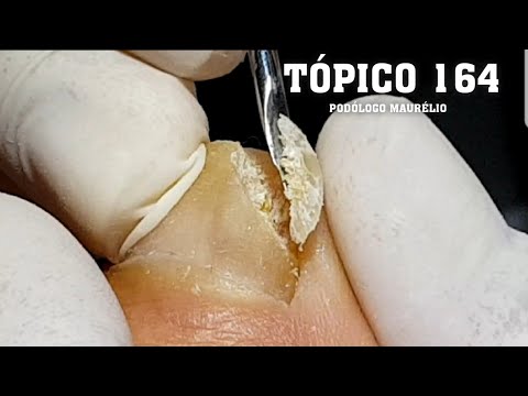 COMO A MICOSE PODE DEIXAR A SUA UNHA (WHAT A MYCHOSIS CAN DO TO YOUR NAIL) - PODÓLOGO MAURÉLIO