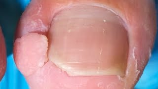 There Are Strange Lumps On My Toenails. Cut Off The Ingrown Toenails!【Crazy pedicure room】
