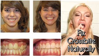 How To Fix Crossbite Teeth Naturally Without Surgery, Without Braces | Cross-Bite Teeth Correction