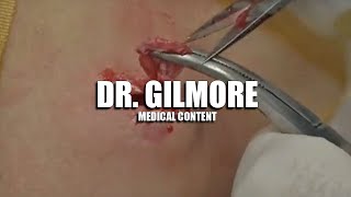 Dr. Gilmore Fan Page!   Must See Extractions