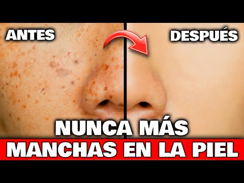 Con SOLO 1 USO ELIMINARÁS las MANCHAS de la PIEL y MARCAS del ACNÉ | Remedio Casero Manchas Oscuras