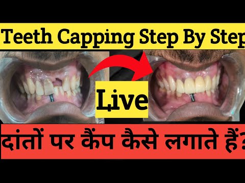 Teeth Capping Process Step By Step |दांतों पर कैप कैसे लगाते हैं? |Zirconia Cap On Teeth |Cap Cost