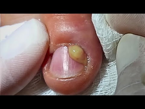 DEDO DA MÃO CHEIO DE PUS #podologomaurelio #viral