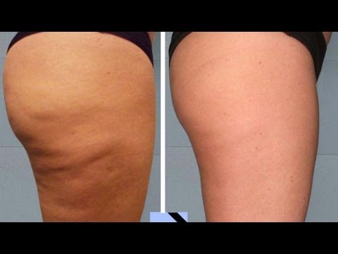 REMEDIOS CASEROS PARA LA CELULITIS