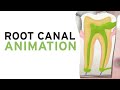 Root Canal Treatment Techniques