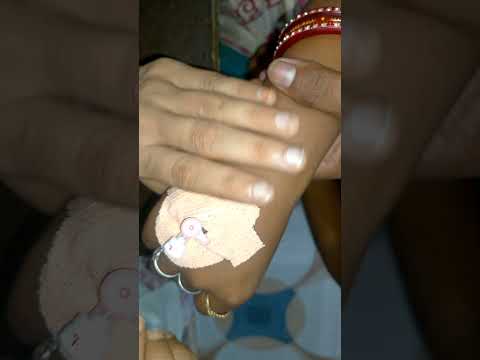 IV Cannulation Technique Porcedure