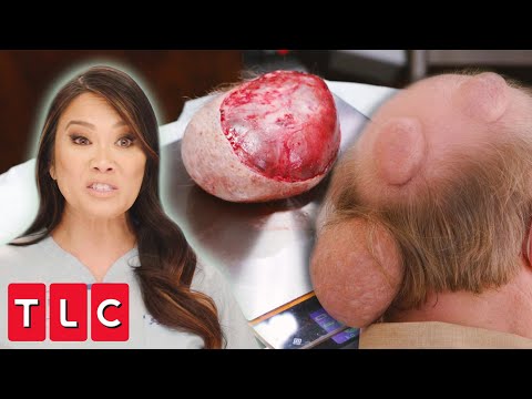 Dr. Lee Removes a 2 Pound Pilar Cyst From Patient's Head! | Dr. Pimple Popper