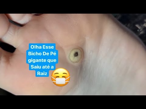 BICHO DE PÉ OLHO O TAMANHO DO OLHO DELE😷 A Little Foot Bug😵 Reaction Podologo Maurelio