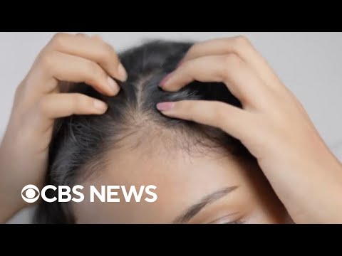 YouTube video thumbnail: 40% of Women Affected by Female Pattern Hair Loss by age 50, Study Finds