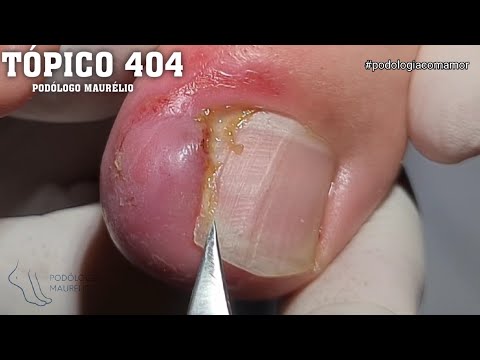 UNHA EMPERRADA (STAKED NAIL) - PODÓLOGO MAURÉLIO