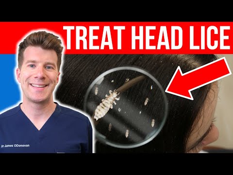 How to TREAT HEAD LICE AND NITS | Doctor's step-by-step guide