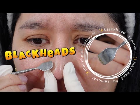 BLACKHEAD REMOVAL TOOLS! (So Satisfying!)